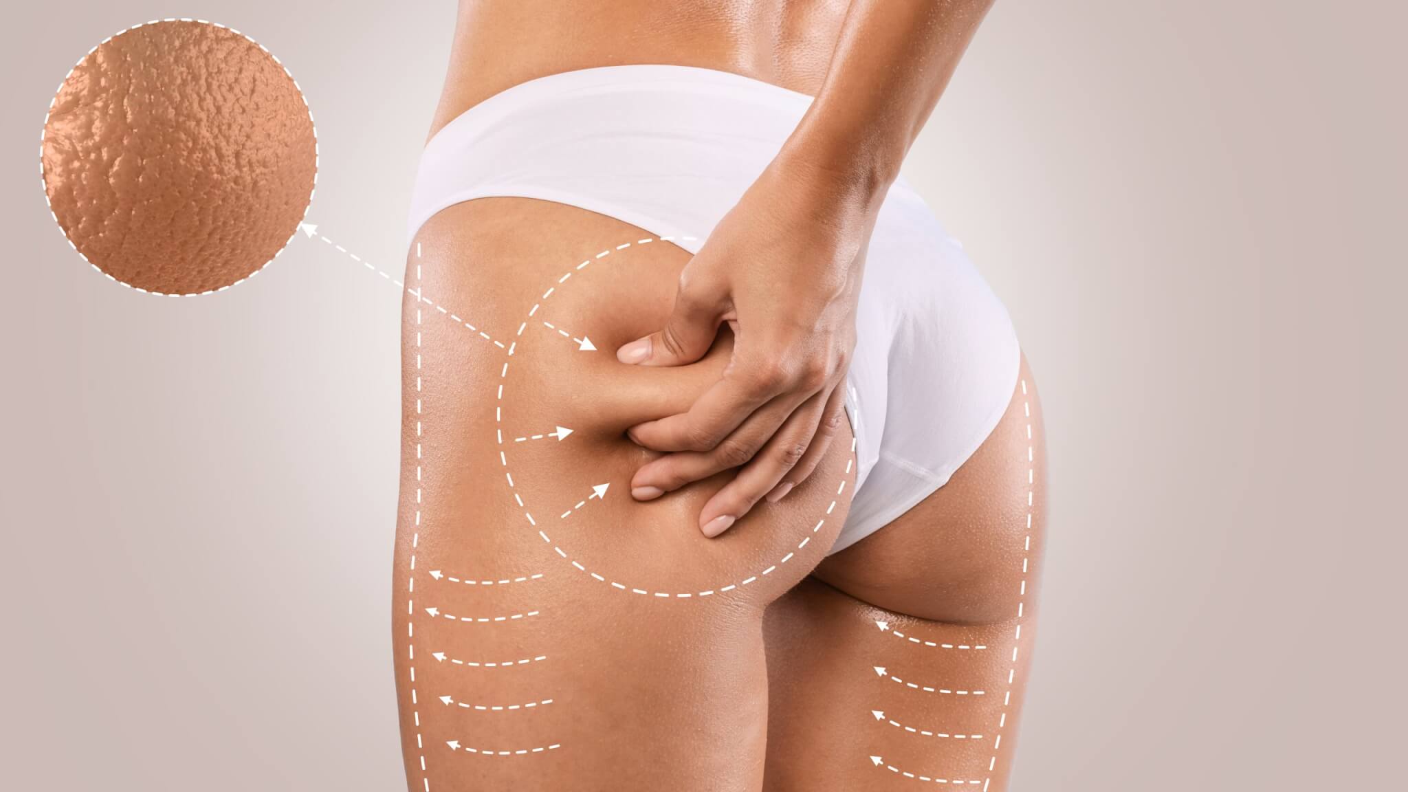 Cellulite: Cause, Tipologie e Come Combatterla con Endermologie LPG