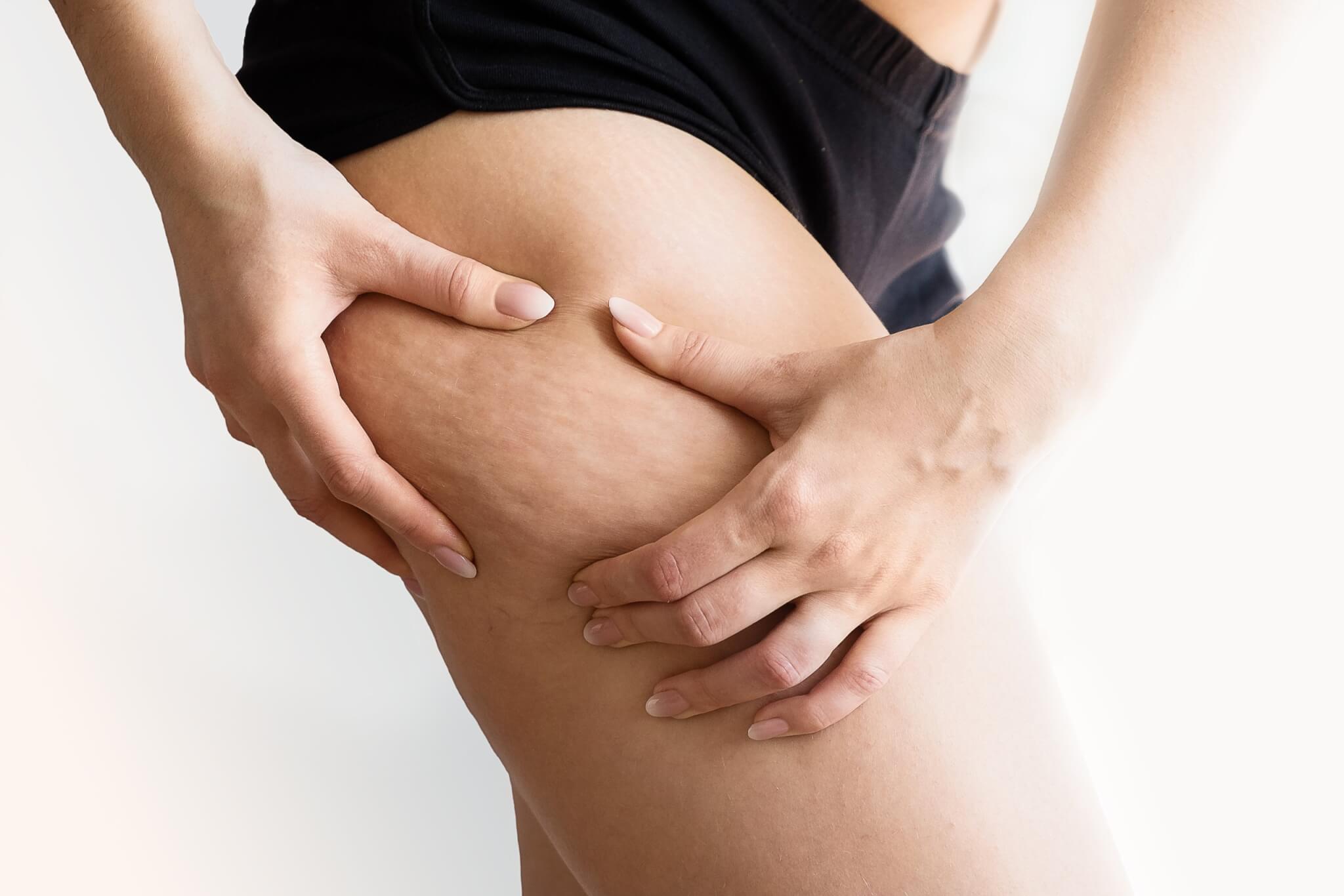 Cellulite: Cause, Tipologie e Come Combatterla con Endermologie LPG